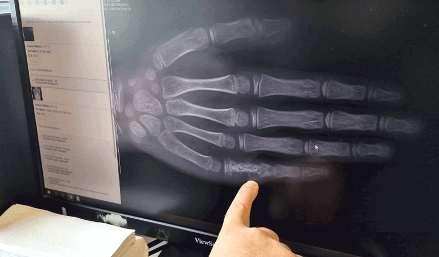 Eskişehir'de her ay 5 ila 7 çocuğa tanı konuluyor! Hayati uyarı